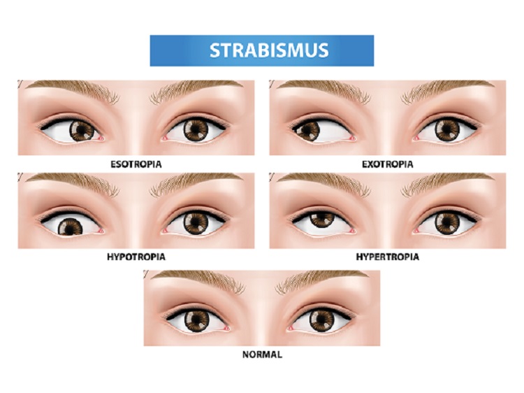 Strabismus - Squint