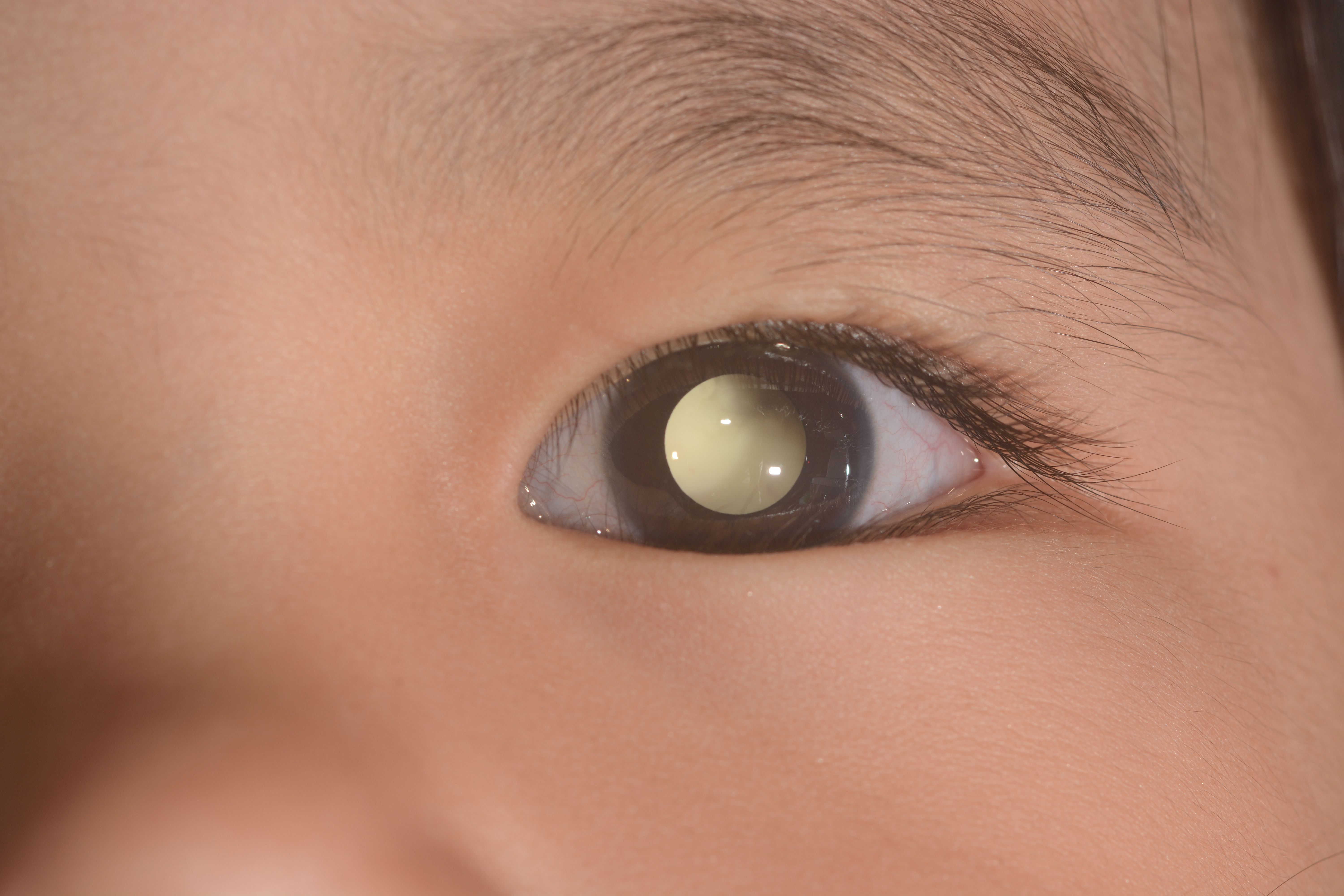Leukocoria - white eye