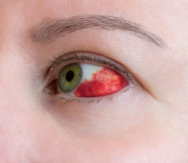 Subconjunctival Hemorrhage