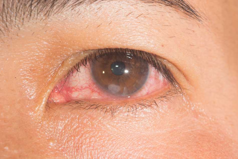 Corneal ulcer